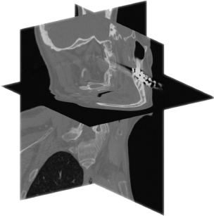 Raw CT scan